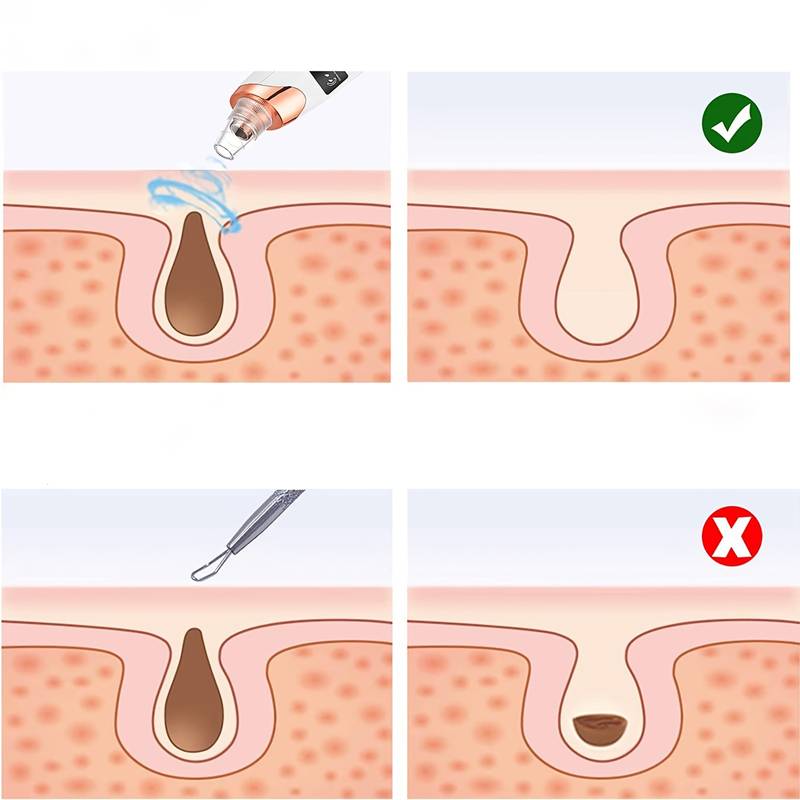 Aspirateur de points noirs, nettoyeur de pores pour visage, élimination des impuretés, appareil facial anti-acné, soin peau en profondeur – Image 3